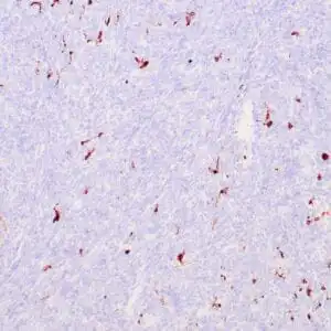 Immunohistochemistry (IHC) : Human sarcoma stained with anti-MMP-2 antibody using peroxidase-conjugate and DAB chromogen. Note the cytoplasmic staining of some tumor cells..