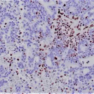 Immunohistochemistry (IHC) : Human colon adenocarcinoma with Lynch syndrome stained with anti-MSH-2 antibody using peroxidase-conjugate and DAB chromogen. Note absence of nuclear staining of tumor cells whereas the background cells are positive.