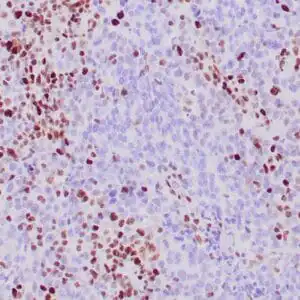 Immunohistochemistry (IHC) : Human colon adenocarcinoma with Lynch syndrome stained with anti-MSH-2 antibody using peroxidase-conjugate and DAB chromogen. Note absence of nuclear staining of tumor cells whereas the background cells are positive.