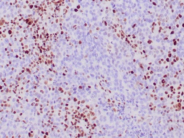 Immunohistochemistry (IHC) : Human colon adenocarcinoma with Lynch syndrome stained with anti-MSH-2 antibody using peroxidase-conjugate and DAB chromogen. Note absence of nuclear staining of tumor cells whereas the background cells are positive.