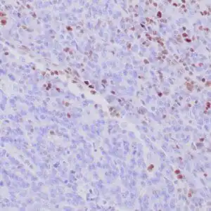 Immunohistochemistry (IHC) : Formalin-fixed, paraffin-embedded human colon carcinoma (Lynch) stained with anti-MSH-6 antibody using peroxidase-conjugate and DAB chromogen. Note the absence of nuclear staining of tumor cells whereas normal lymphocytes and stromal cells are positive.