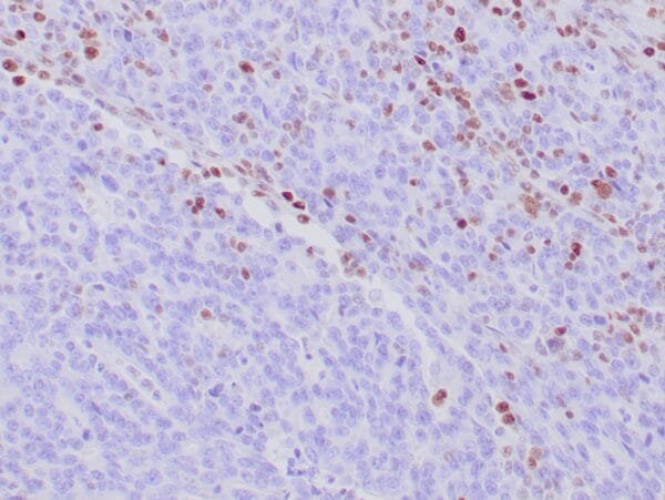 Immunohistochemistry (IHC) : Formalin-fixed, paraffin-embedded human colon carcinoma (Lynch) stained with anti-MSH-6 antibody using peroxidase-conjugate and DAB chromogen. Note the absence of nuclear staining of tumor cells whereas normal lymphocytes and stromal cells are positive.