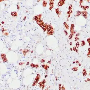 Immunohistochemistry (IHC) : Human cholangiocarcinoma stained with anti-MUC-1 antibody using peroxidase-conjugate and DAB chromogen. Note the cytoplasmic staining of tumor cells.