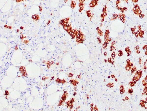 Immunohistochemistry (IHC) : Human cholangiocarcinoma stained with anti-MUC-1 antibody using peroxidase-conjugate and DAB chromogen. Note the cytoplasmic staining of tumor cells.