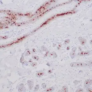 Immunohistochemistry (IHC) : Human cholangiocarcinoma stained with anti-MUC-1 antibody using peroxidase-conjugate and DAB chromogen. Note the cytoplasmic staining of tumor cells.