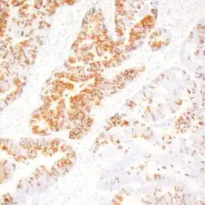 Immunohistochemistry (IHC) : Human colon adenocarcinoma stained with anti-MUC-2 antibody using peroxidase-conjugate and DAB chromogen. Note the cytoplasmic staining of tumor cells.