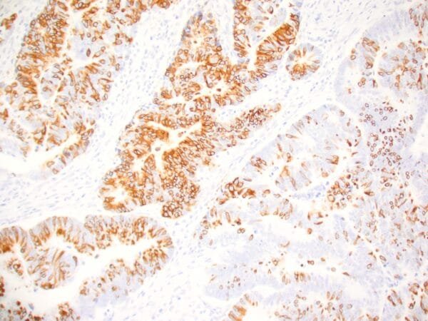 Immunohistochemistry (IHC) : Human colon adenocarcinoma stained with anti-MUC-2 antibody using peroxidase-conjugate and DAB chromogen. Note the cytoplasmic staining of tumor cells.