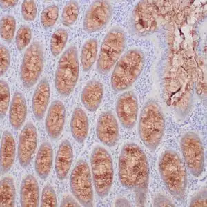 Immunohistochemistry (IHC) : Human sclerosing fibrosarcoma stained with anti-MUC-4 antibody using peroxidase-conjugate and DAB chromogen. Note cytoplasmic staining of tumor cells.
