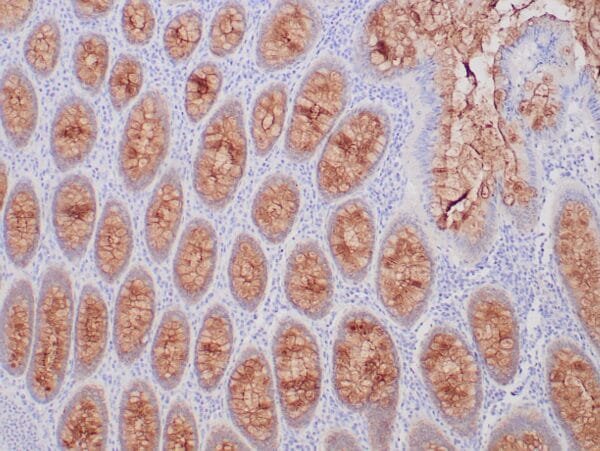 Immunohistochemistry (IHC) : Human sclerosing fibrosarcoma stained with anti-MUC-4 antibody using peroxidase-conjugate and DAB chromogen. Note cytoplasmic staining of tumor cells.