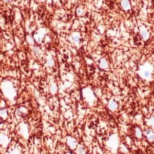 Immunohistochemistry (IHC) : Human brain white mater stained with anti-MBP antibody using peroxidase-conjugate and DAB chromogen. Note the cytoplasmic staining of glial cells.