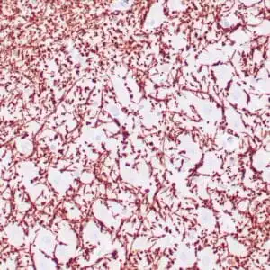 Immunohistochemistry (IHC) : Human brain white mater stained with anti-MBP antibody using peroxidase-conjugate and DAB chromogen. Note the cytoplasmic staining of glial cells.