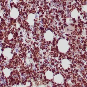 Immunohistochemistry (IHC) : Formalin-fixed, paraffin-embedded human bone marrow stained with anti-myeloperoxidase antibody  using peroxidase-conjugate and DAB chromogen. Note the cytoplasmic staining of myeloid cells