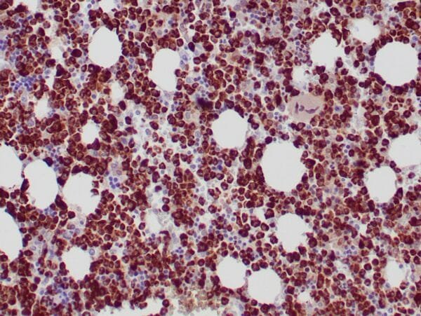 Immunohistochemistry (IHC) : Formalin-fixed, paraffin-embedded human bone marrow stained with anti-myeloperoxidase antibody  using peroxidase-conjugate and DAB chromogen. Note the cytoplasmic staining of myeloid cells