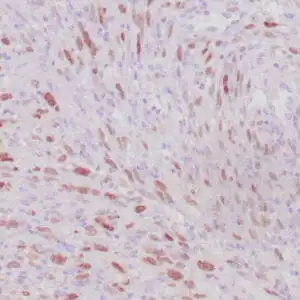 Immunohistochemistry (IHC) : Human rhabdomyosarcoma stained with anti-MyoD1 antibody using peroxidase-conjugate and DAB chromogen. Note the nuclear staining of sarcoma cells.