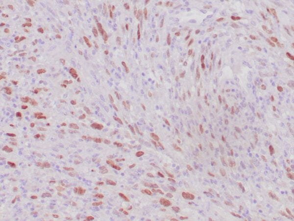 Immunohistochemistry (IHC) : Human rhabdomyosarcoma stained with anti-MyoD1 antibody using peroxidase-conjugate and DAB chromogen. Note the nuclear staining of sarcoma cells.