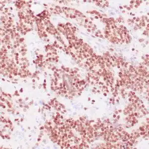 Immunohistochemistry (IHC) : Human rhabdomyosarcoma stained with anti-Myogenin antibody using peroxidase-conjugate and DAB chromogen. Note nuclear staining of tumor cells.