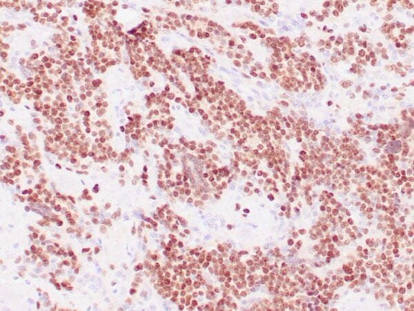 Immunohistochemistry (IHC) : Human rhabdomyosarcoma stained with anti-Myogenin antibody using peroxidase-conjugate and DAB chromogen. Note nuclear staining of tumor cells.