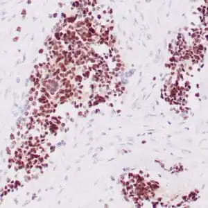 Immunohistochemistry (IHC) : Human rhabdomyosarcoma stained with anti-Myogenin antibody using peroxidase-conjugate and DAB chromogen. Note nuclear staining of tumor cells.
