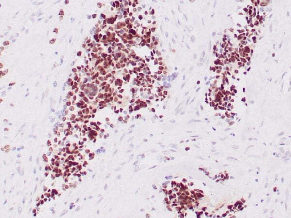 Immunohistochemistry (IHC) : Human rhabdomyosarcoma stained with anti-Myogenin antibody using peroxidase-conjugate and DAB chromogen. Note nuclear staining of tumor cells.