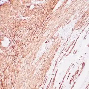 Immunohistochemistry (IHC) : Human colon wall stained with anti-SMMH antibody using peroxidase-conjugate and DAB chromogen. Note cytoplasmic staining of smooth muscle and vessel wall.