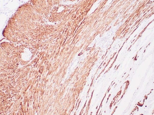 Immunohistochemistry (IHC) : Human colon wall stained with anti-SMMH antibody using peroxidase-conjugate and DAB chromogen. Note cytoplasmic staining of smooth muscle and vessel wall.