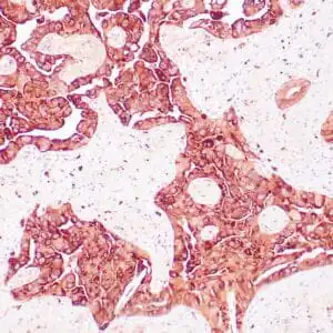 Immunohistochemistry (IHC) : Human lung adenocarcinoma stained with anti-Napsin-A antibody using peroxidase-conjugate and DAB chromogen. Note cytopasmic staining carcinoma cells.