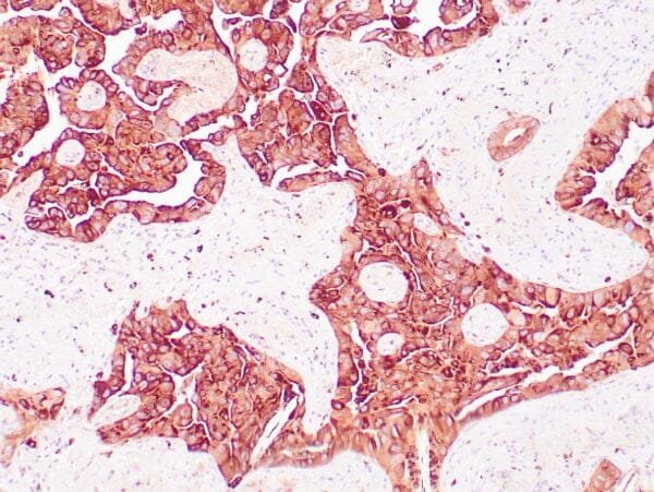 Immunohistochemistry (IHC) : Human lung adenocarcinoma stained with anti-Napsin-A antibody using peroxidase-conjugate and DAB chromogen. Note cytopasmic staining carcinoma cells.