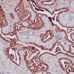 Immunohistochemistry (IHC) : Formalin-fixed, paraffin-embedded human lung adenocarcinoma stained with anti-napsin A antibody using peroxidase-conjugate and DAB chromogen. Note cytoplasmic staining carcinoma cells