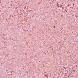 Immunohistochemistry (IHC) : Human malignant melanoma stained with anti-NGFR antibody using peroxidase-conjugate and DAB chromogen. Note the cytoplasmic staining of tumor cells.