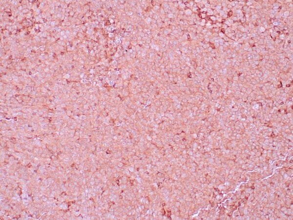 Immunohistochemistry (IHC) : Human malignant melanoma stained with anti-NGFR antibody using peroxidase-conjugate and DAB chromogen. Note the cytoplasmic staining of tumor cells.