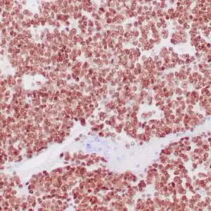Immunohistochemistry (IHC) : Human Ewing’s sarcoma stained with anti-NKX2.2 antibody using peroxidase-conjugate and DAB chromogen. Note nuclear staining of tumor cells.