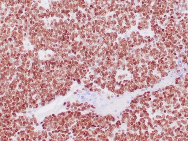 Immunohistochemistry (IHC) : Human Ewing’s sarcoma stained with anti-NKX2.2 antibody using peroxidase-conjugate and DAB chromogen. Note nuclear staining of tumor cells.