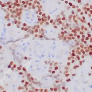 Immunohistochemistry (IHC) : Human Ewing’s sarcoma stained with anti-NKX2.2 antibody using peroxidase-conjugate and DAB chromogen. Note nuclear staining of tumor cells.