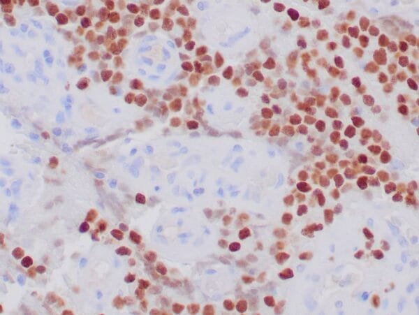 Immunohistochemistry (IHC) : Human Ewing’s sarcoma stained with anti-NKX2.2 antibody using peroxidase-conjugate and DAB chromogen. Note nuclear staining of tumor cells.