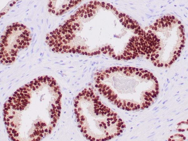 Immunohistochemistry (IHC) : Human prostate stained with anti-NKX3.1 antibody using peroxidase-conjugate and DAB chromogen. Note nuclear staining of glandular cells.