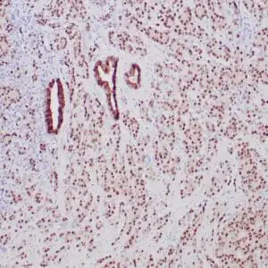 Immunohistochemistry (IHC) : Formalin-fixed, paraffin-embedded prostate adenocarcinoma stained with anti-NKX3.1 antibody using peroxidase-conjugate and DAB chromogen. Note nuclear staining of tumor cells