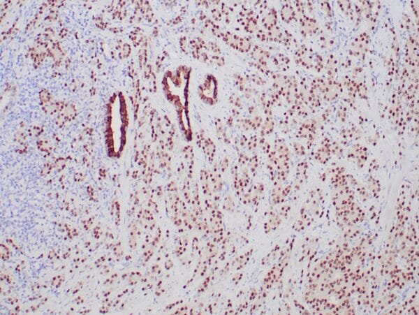 Immunohistochemistry (IHC) : Formalin-fixed, paraffin-embedded prostate adenocarcinoma stained with anti-NKX3.1 antibody using peroxidase-conjugate and DAB chromogen. Note nuclear staining of tumor cells