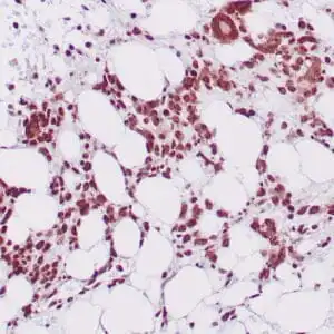 Immunohistochemistry (IHC) : Human bone marrow stained with anti-NPM1 antibody using peroxidase-conjugate and DAB chromogen. Note nuclear staining of myeloid cells.