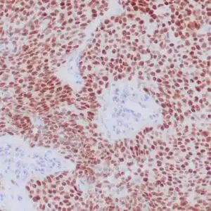 Immunohistochemistry (IHC) : Formalin-fixed, paraffin-embedded human NUT carcinoma stained with anti-NUT antibody using peroxidase-conjugate and DAB chromogen. Note nuclear staining of tumor cells