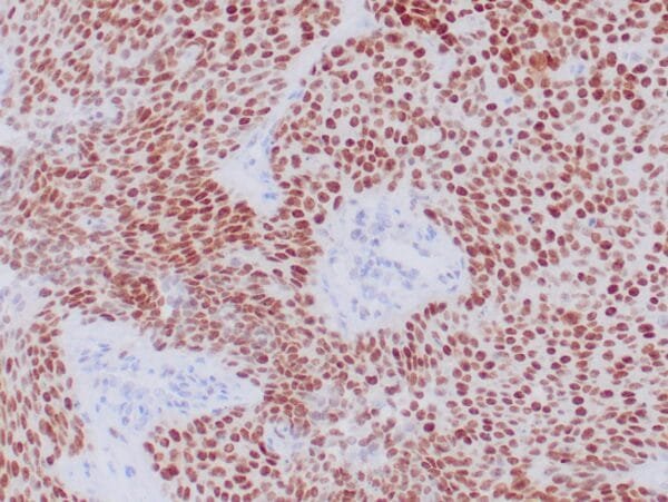 Immunohistochemistry (IHC) : Formalin-fixed, paraffin-embedded human NUT carcinoma stained with anti-NUT antibody using peroxidase-conjugate and DAB chromogen. Note nuclear staining of tumor cells