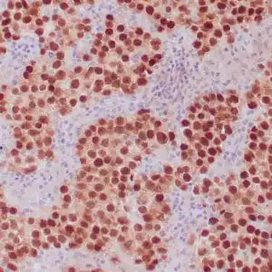 Immunohistochemistry (IHC) : Human seminoma stained with anti-OCT-4 antibody using peroxidase-conjugate and DAB chromogen. Note the nuclear staining of tumor cells.
