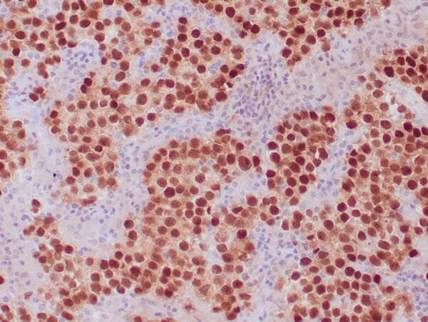 Immunohistochemistry (IHC) : Human seminoma stained with anti-OCT-4 antibody using peroxidase-conjugate and DAB chromogen. Note the nuclear staining of tumor cells.