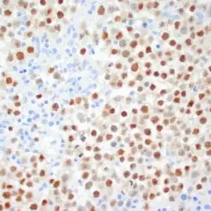 Immunohistochemistry (IHC) : Human seminoma stained with anti-OCT-4 antibody using peroxidase-conjugate and DAB chromogen. Note the nuclear staining of seminoma cells.