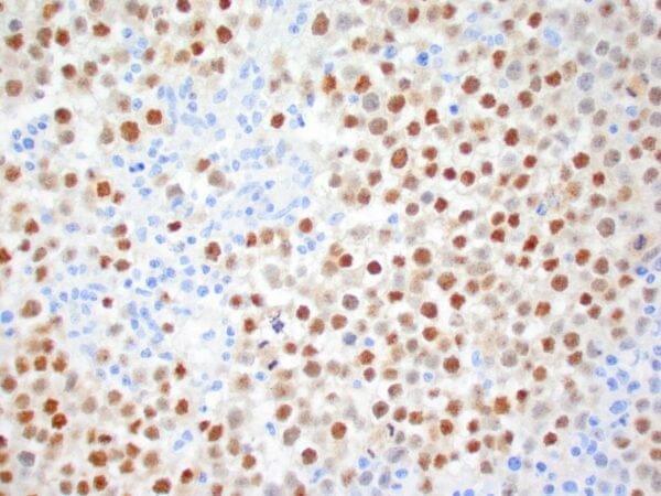 Immunohistochemistry (IHC) : Human seminoma stained with anti-OCT-4 antibody using peroxidase-conjugate and DAB chromogen. Note the nuclear staining of seminoma cells.