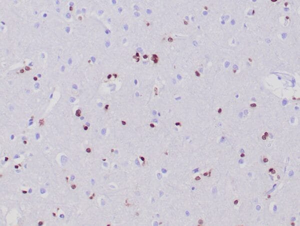 Immunohistochemistry (IHC) : Human cerebrum stained with anti-Olig 2 antibody using peroxidase-conjugate and DAB chromogen. Note the nuclear staining of oligodendroglial cells.