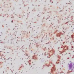 Immunohistochemistry (IHC) : Human breast lobular carcinoma stained with anti-P120 antibody using peroxidase-conjugate and DAB chromogen. Note: the cytoplasmic staining of lobular carcinoma cells and membranous staining of ductal epithelium (lower field).
