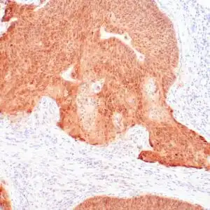 Immunohistochemistry (IHC) : High grade cervical intraepithelial neoplasia (CINIII) stained with anti-p16 antibody using peroxidase-conjugate and DAB chromogen. Note the nuclear and cytoplasmic staining of dysplastic cells, whereas the normal squamoujs mucosa is negative.