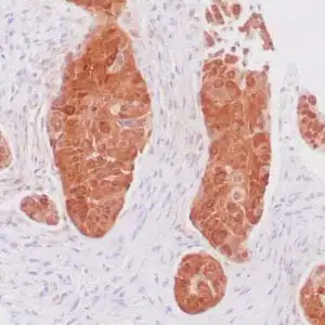 Immunohistochemistry (IHC) : Invasive cervical squamous cell carcinoma stained with anti-p16 antibody using peroxidase-conjugate and DAB chromogen. Note the nuclear and cytoplasmic staining of carcinoma cells.