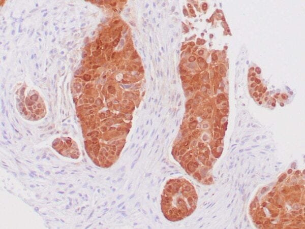 Immunohistochemistry (IHC) : Invasive cervical squamous cell carcinoma stained with anti-p16 antibody using peroxidase-conjugate and DAB chromogen. Note the nuclear and cytoplasmic staining of carcinoma cells.