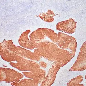 Immunohistochemistry (IHC) : Cervical invasive squamous cell carcinoma stained with anti-p16 antibody using peroxidase-conjugate and DAB chromogen.  Note the nuclear and cytoplasmic staining of dysplastic cells.